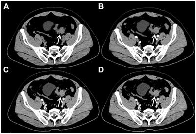 Case report: A rare case of isolated sigmoid Rosai-Dorfman disease on contrast-enhanced CT and 18F-FDG PET/CT